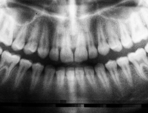 Come rimuovere i denti del giudizio prima che si formino