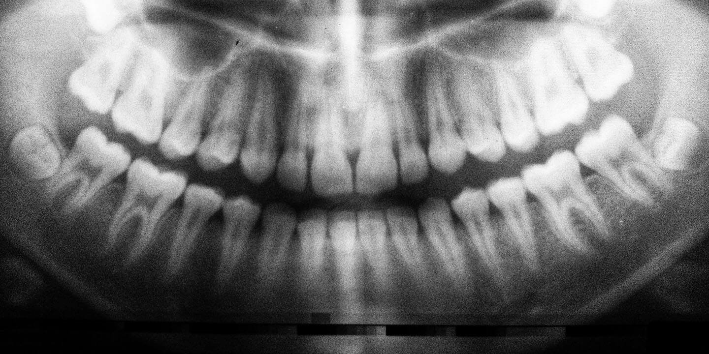 Come rimuovere i denti del giudizio prima che si formino