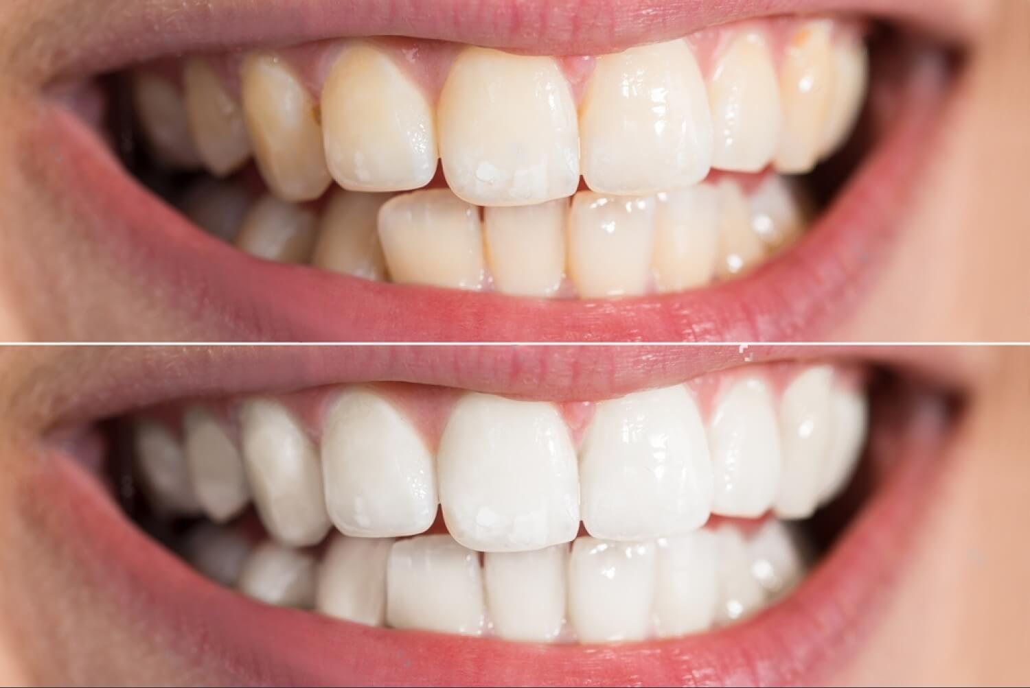Sbiancamento dentale professionale: vale la pena investirci?