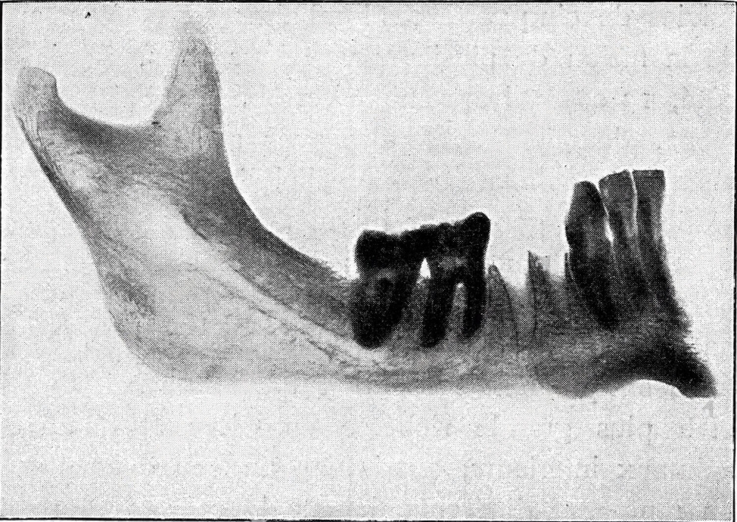 Perché i denti del giudizio si chiamano cosi?