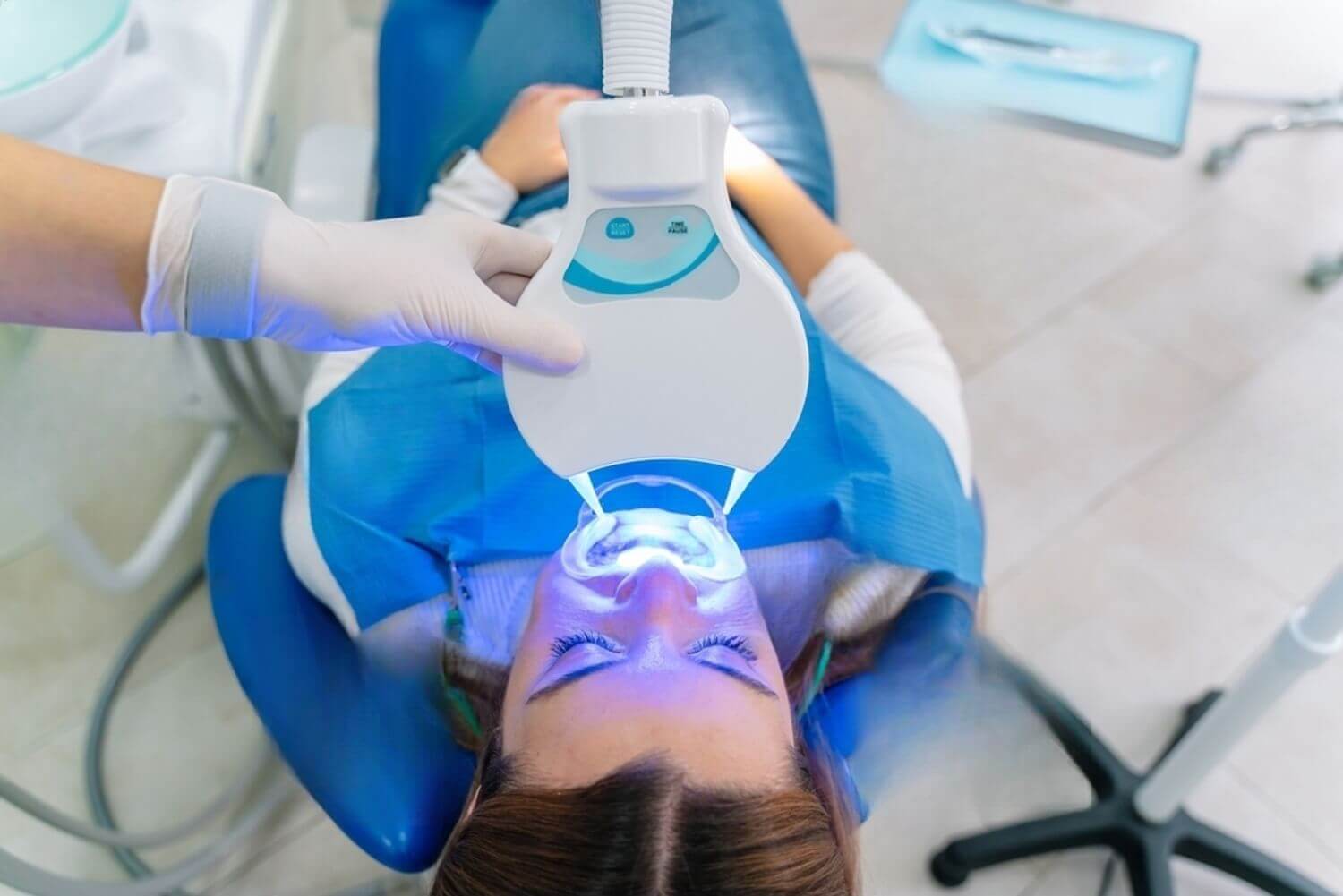 Sbiancamento dentale: Professionale vs Fai da te